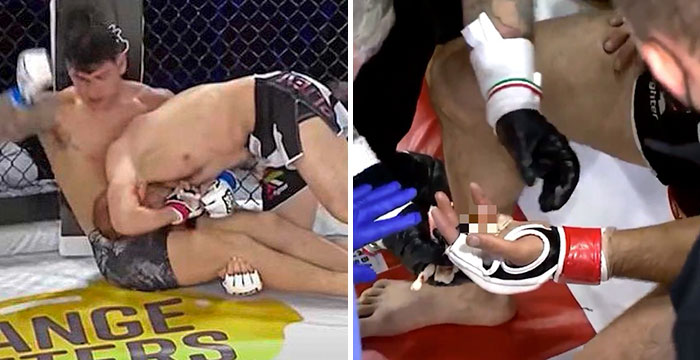 mma fighter loses his finger