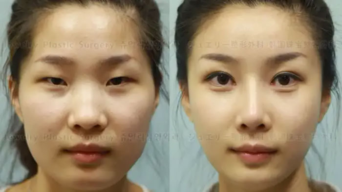 south korean plastic surgery