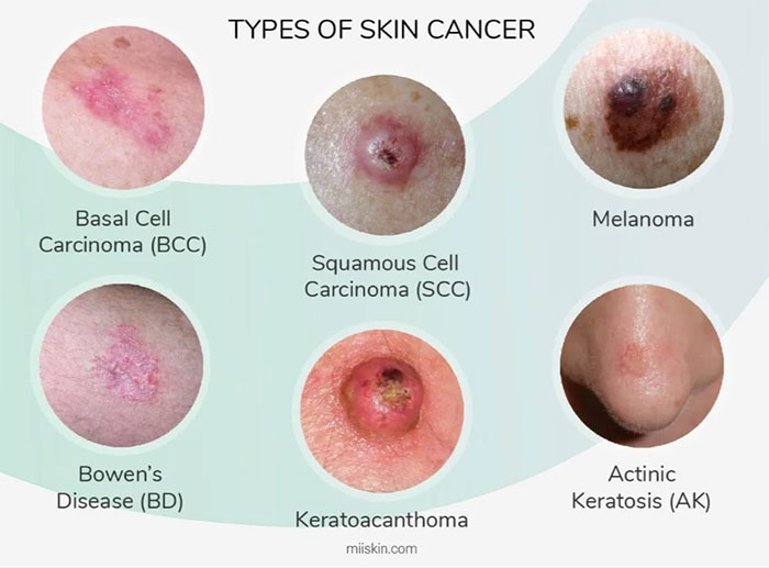 types of skin cancer
